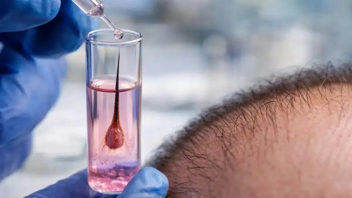 Vědci vypěstovali funkční vlasové folikuly v laboratoři: Revoluce v boji proti plešatosti?