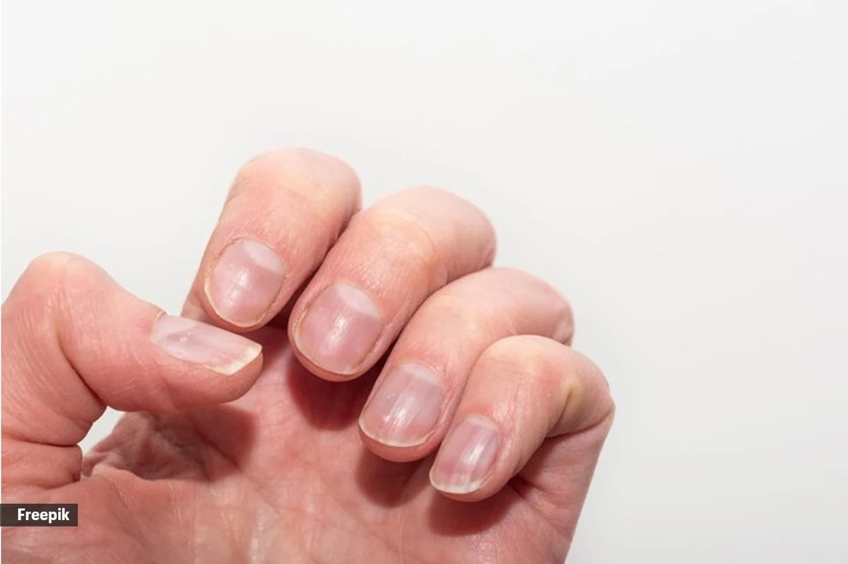 Co vaše nehty prozrazují o zdraví: Varovné signály i příznaky rakoviny - image 1